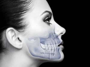 Black and white photo of a woman's face in profile overlaid with an illustration of a jaw that has undergone orthognathic surgery
